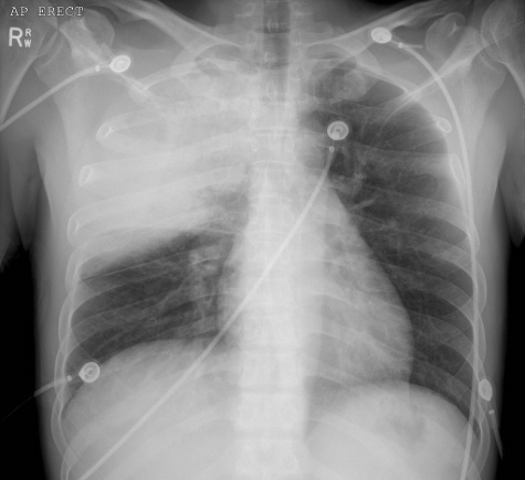 cxr